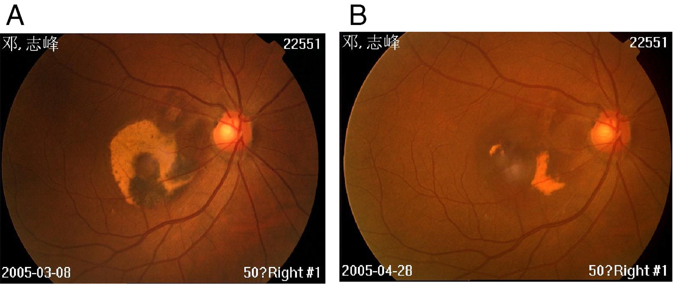 Macular Degeneration Standard Program - Wise Choice Medicine